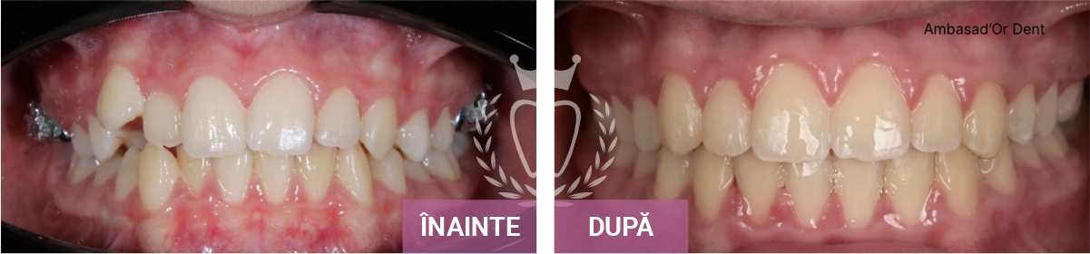 aparat-dentar-piatra-neamt